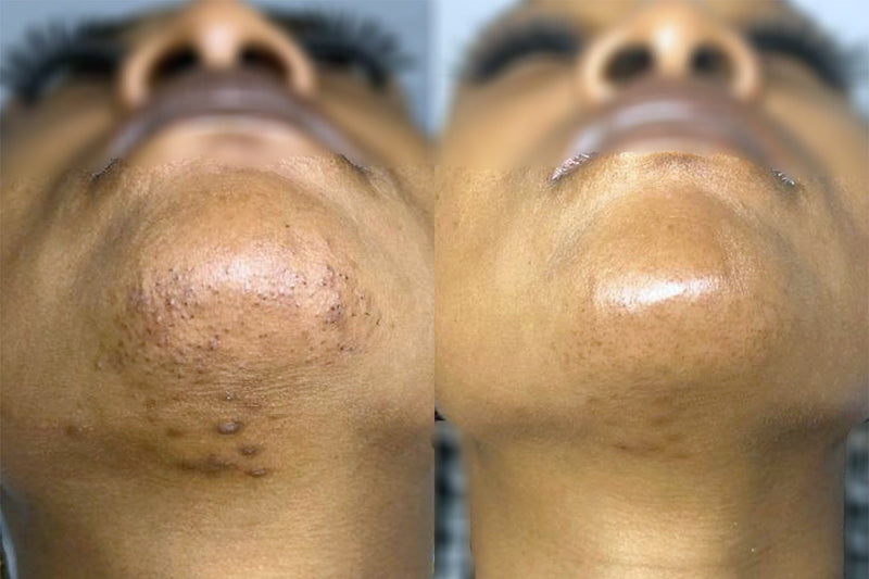 Before and after comparison of a neck treatment by Albany Laser & Cosmetic Center.
